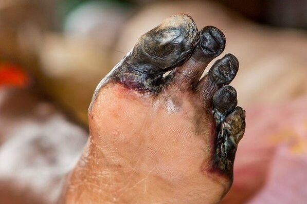 Cenen des doigts des pieds en diat